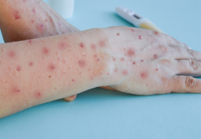 Sesap descarta Mpox em paciente internada em Mossoró Sesap descarta Mpox em paciente internada em Mossoró