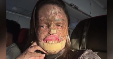 Morre Karine Felipe, influencer que lutava contra doença genética rara de pele Morre Karine Felipe, influencer que lutava contra doença genética rara de pele