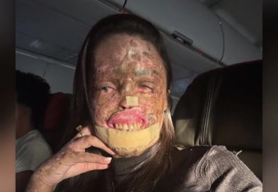 Morre Karine Felipe, influencer que lutava contra doença genética rara de pele Morre Karine Felipe, influencer que lutava contra doença genética rara de pele